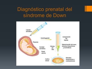 Diagnóstico prenatal del
síndrome de Down
 