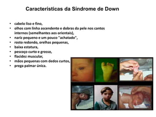Características da Síndrome de Down
• cabelo liso e fino,
• olhos com linha ascendente e dobras da pele nos cantos
internos (semelhantes aos orientais),
• nariz pequeno e um pouco "achatado",
• rosto redondo, orelhas pequenas,
• baixa estatura,
• pescoço curto e grosso,
• flacidez muscular,
• mãos pequenas com dedos curtos,
• prega palmar única.
 