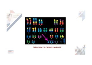 TRISSOMIA DO CROMOSSOMO 21
 