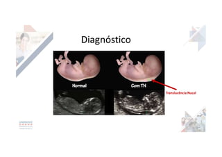 Diagnóstico
Translucência Nucal
 