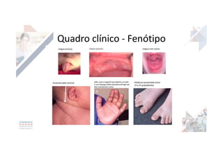 Quadro clínico - Fenótipo
 