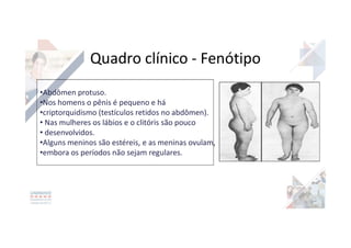•Abdômen protuso.
•Nos homens o pênis é pequeno e há
•criptorquidismo (testículos retidos no abdômen).
• Nas mulheres os lábios e o clitóris são pouco
• desenvolvidos.
•Alguns meninos são estéreis, e as meninas ovulam,
•embora os períodos não sejam regulares.
Quadro clínico - Fenótipo
 