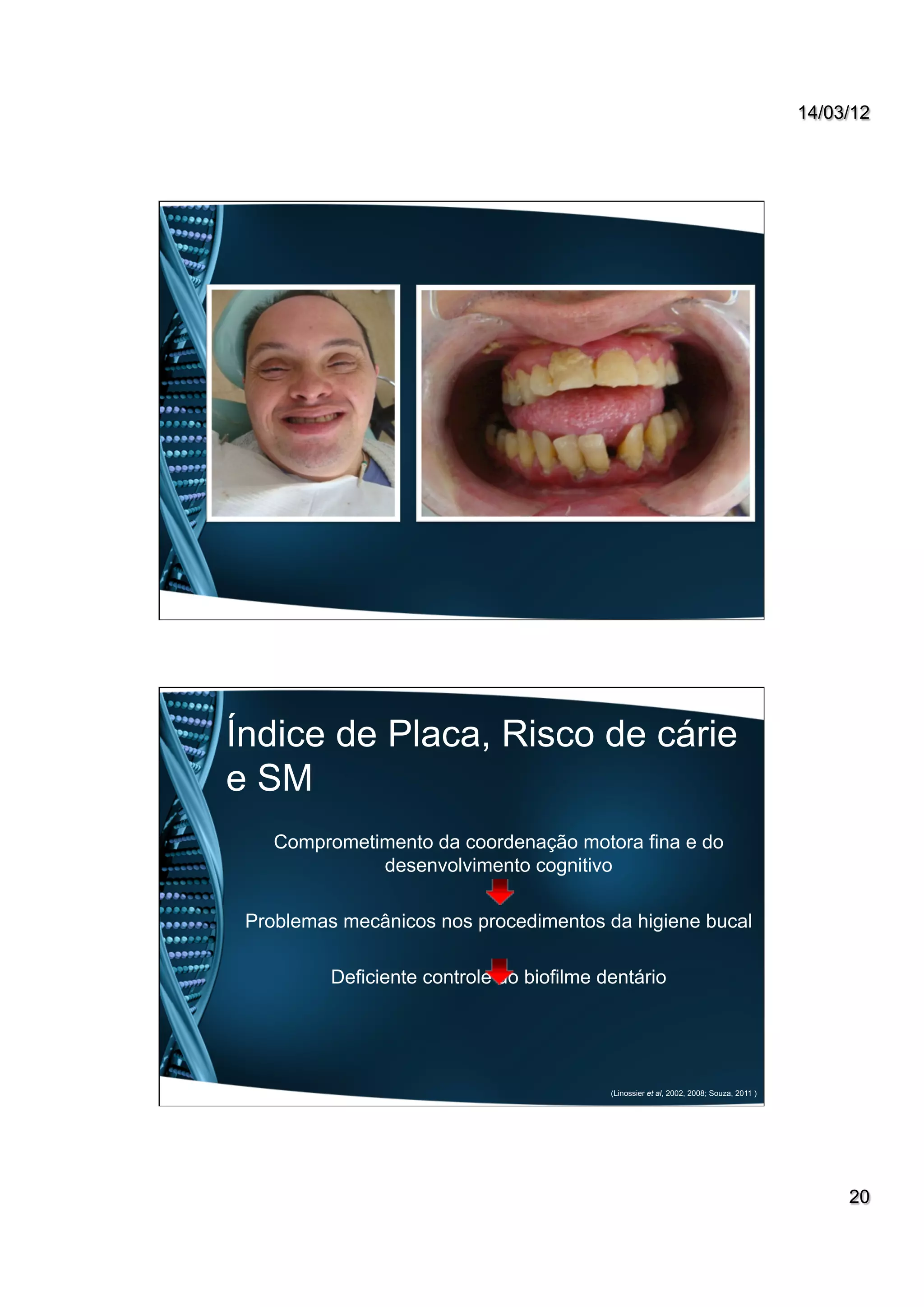 14/03/12
20
Comprometimento da coordenação motora fina e do
desenvolvimento cognitivo
Problemas mecânicos nos procedimentos da higiene bucal
Deficiente controle do biofilme dentário
(Linossier et al, 2002, 2008; Souza, 2011 )
Índice de Placa, Risco de cárie
e SM
 