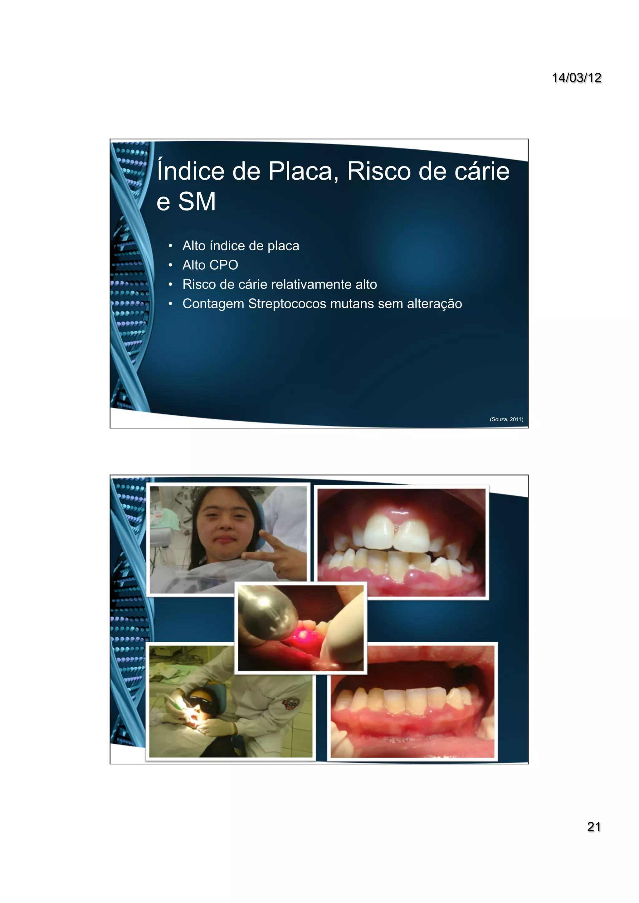 14/03/12
21
•  Alto índice de placa
•  Alto CPO
•  Risco de cárie relativamente alto
•  Contagem Streptococos mutans sem alteração
(Souza, 2011)
Índice de Placa, Risco de cárie
e SM
 