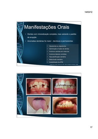 14/03/12
17
Manifestações Orais
•  Dentes com mineralização completa, mas variando o padrão
de erupção
•  Anomalias dentárias 5x maior - decíduos e permanentes
•  Hipodontia ou oligodontia
•  Geminação e fusão de dentes
•  Incisivos centrais em meia lua
•  Incisivos laterais conóides
•  Hipocalcificação dentária
•  Maloclusão dentária
•  Instabilidade da ATM
(Lopez-Perez, 2002; Oliveira et al, 2007; 2008; Oredugba e Akindaomi, 2008)
 