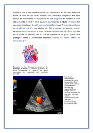sospecha por lo que pueden quedar sin diagnosticar en la etapa neonatal
hasta un 50% de los recién nacidos con cardiopatía congénita. Por este
motivo se recomienda la realización de una ecografía del corazón a todo
recién nacido con SD.25 En la etapa de adolescencia o adulto joven pueden
aparecer defectos en las válvulas cardíacas (Con mayor frecuencia, prolapso
de la válvula mitral). Los adultos con SD presentan, en cambio, menor
riesgo de arterioesclerosis y unas cifras de tensión arterial inferiores a las
de la población general, por lo que se consideran un grupo poblacional
protegido frente a enfermedad coronaria (angina de pecho, infarto de
miocardio…).26

Diagrama de los defectos presentes en la
tetralogía de Fallot: A. Estenosis pulmonar, B.
Aorta acabalgada, C. Defecto del septo
ventricular, D. Hipertrofia del ventrículo
derecho.
Eco-Doppler
demostrando
insuficiencia mitral
(incapacidad de la
válvula para cerrarse
completamente,
provocando
regurgitación de
sangre hacia la
aurícula izquierda, en
azul. Esta patología
valvular
degenerativa puede
aparecer
precozmente en
personas con SD.

 
