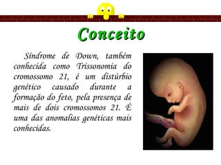 Conceito Síndrome de Down, também conhecida   como Trissonomia do cromossomo 21, é um distúrbio genético causado durante a formação do feto,  pela presença de mais de dois cromossomos 21.  É uma das anomalias genéticas mais conhecidas. 