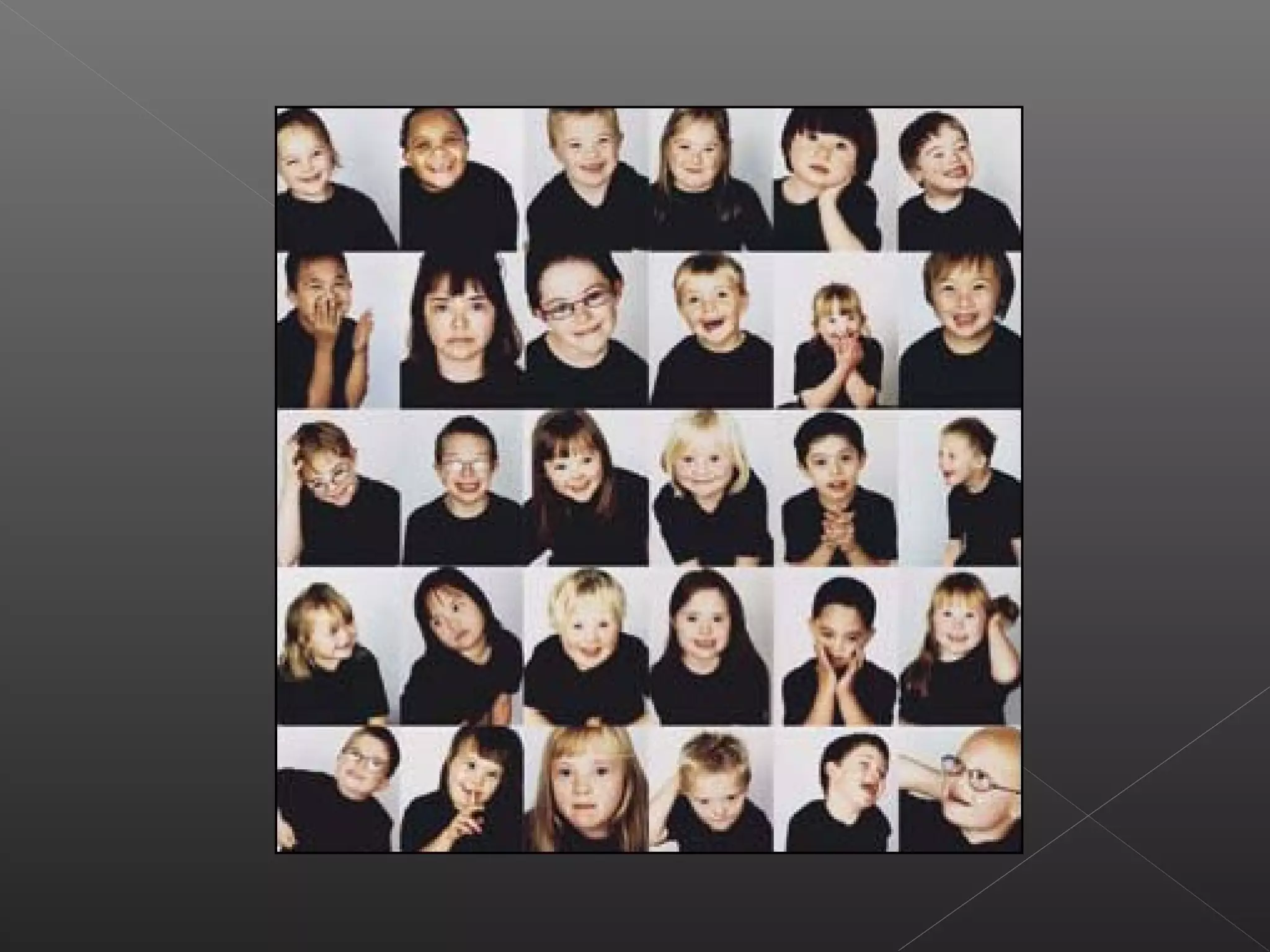 Sindrome de down_ou_trissomia_de_cromossoma_21