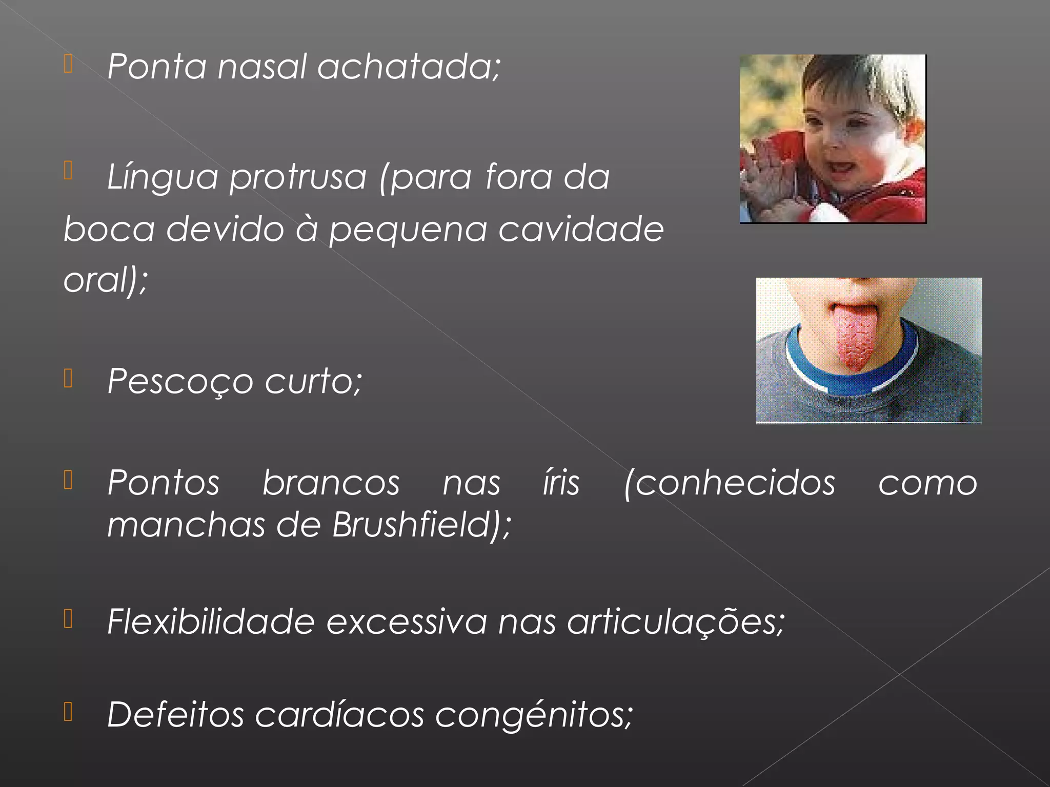  Ponta nasal achatada;
 Língua protrusa (para fora da
boca devido à pequena cavidade
oral);
 Pescoço curto;
 Pontos brancos nas íris (conhecidos como
manchas de Brushfield);
 Flexibilidade excessiva nas articulações;
 Defeitos cardíacos congénitos;
 