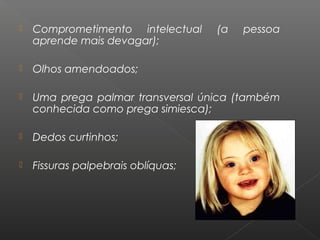  Comprometimento intelectual (a pessoa
aprende mais devagar);
 Olhos amendoados;
 Uma prega palmar transversal única (também
conhecida como prega simiesca);
 Dedos curtinhos;
 Fissuras palpebrais oblíquas;
 