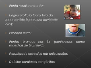  Ponta nasal achatada;
 Língua protrusa (para fora da
boca devido à pequena cavidade
oral);
 Pescoço curto;
 Pontos brancos nas íris (conhecidos como
manchas de Brushfield);
 Flexibilidade excessiva nas articulações;
 Defeitos cardíacos congénitos;
 