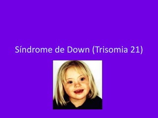 Síndrome de Down (Trisomia 21)
 