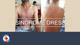 Sindrome de Dress.pptx