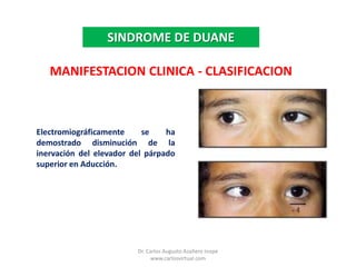 Dr. Carlos Augusto Azañero Inope    www.carlosvirtual.comSINDROME DE DUANEMANIFESTACION CLINICA - CLASIFICACIONElectromiográficamente se ha demostrado disminución de la inervación del elevador del párpado superior en Aducción.