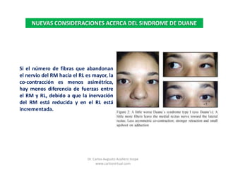 NUEVAS CONSIDERACIONES ACERCA DEL SINDROME DE DUANESi el número de fibras que abandonan el nervio del RM hacia el RL es mayor, la co-contracción es menos asimétrica, hay menos diferencia de fuerzas entre el RM y RL, debido a que la inervación del RM está reducida y en el RL está incrementada.Dr. Carlos Augusto Azañero Inope    www.carlosvirtual.com