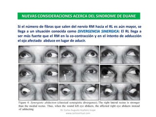 NUEVAS CONSIDERACIONES ACERCA DEL SINDROME DE DUANESi el número de fibras que salen del nervio RM hacia el RL es aún mayor, se llega a un situación conocida como DIVERGENCIA SINERGICA: El RL llega a ser más fuerte que el RM en la co-contracción y en el intento de adducción el ojo afectado  abduce en lugar de aducir.Dr. Carlos Augusto Azañero Inope    www.carlosvirtual.com
