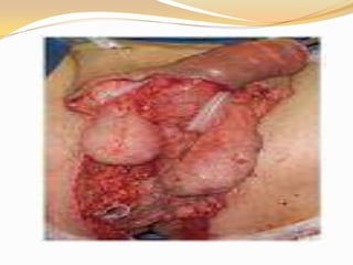 Sindrome de fournier