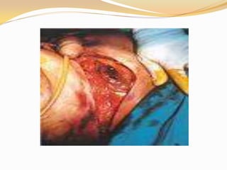 Sindrome de fournier