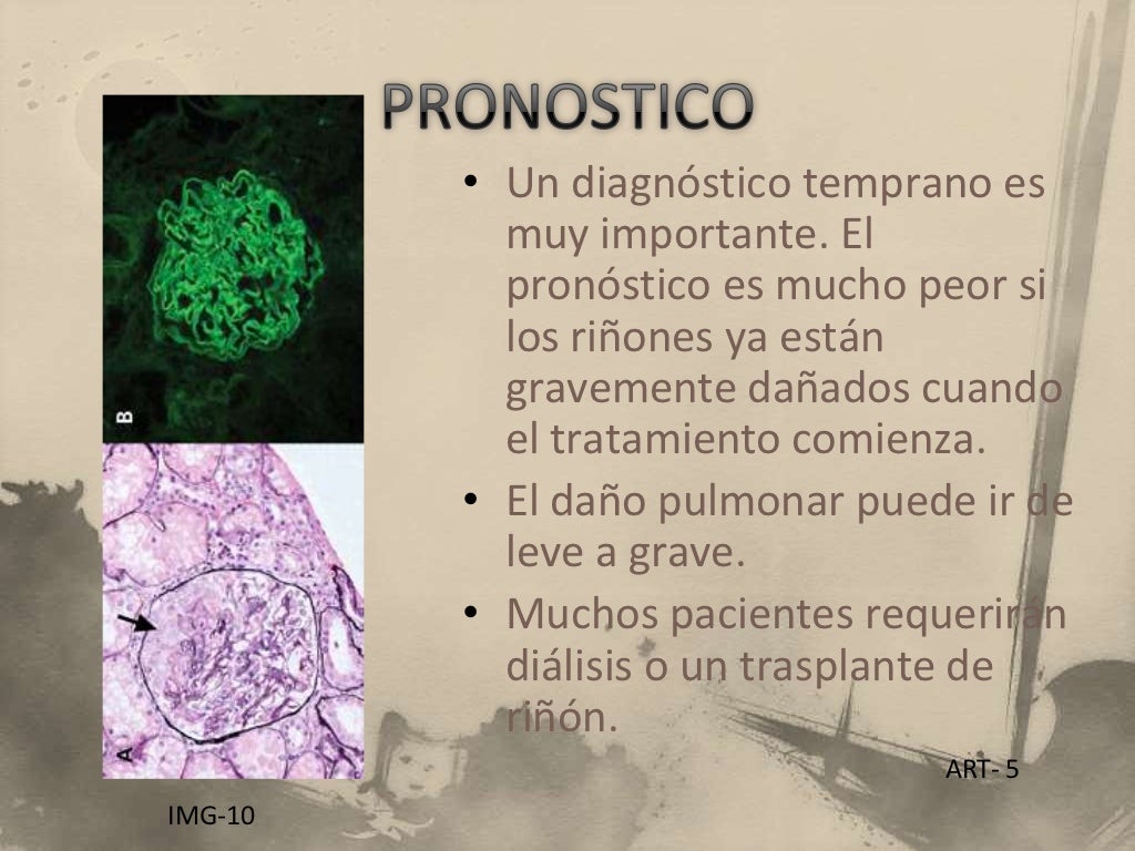 Sindrome de goodpasture