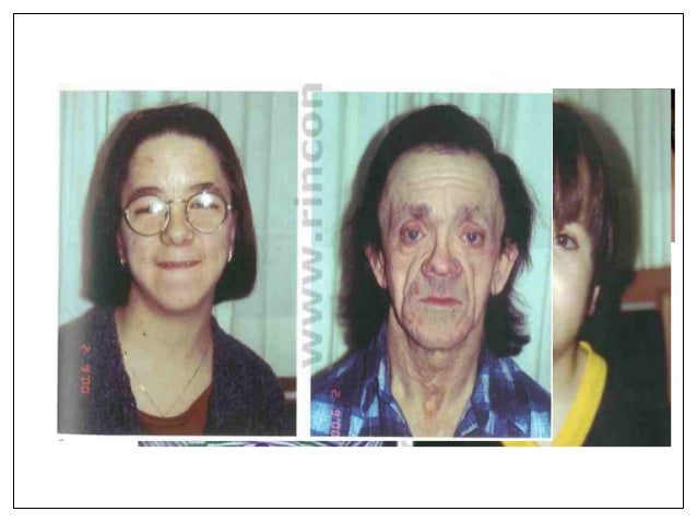 Sindrome de Hajdu Cheney