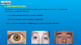 sindrome de horner. Causas, características y tratamientos | PPTX