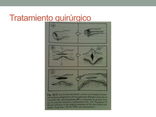 Tratamiento quirúrgico
 