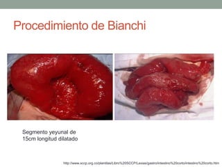 Procedimiento de Bianchi




 Segmento yeyunal de
 15cm longitud dilatado



                 http://www.sccp.org.co/plantilas/Libro%20SCCP/Lexias/gastro/intestino%20corto/intestino%20corto.htm
 