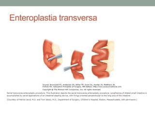 Enteroplastia transversa
 