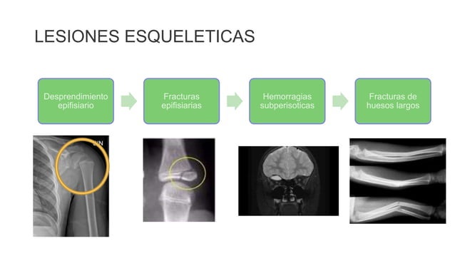 SINDROME DE KEMPE ANGUIANO.pptx
