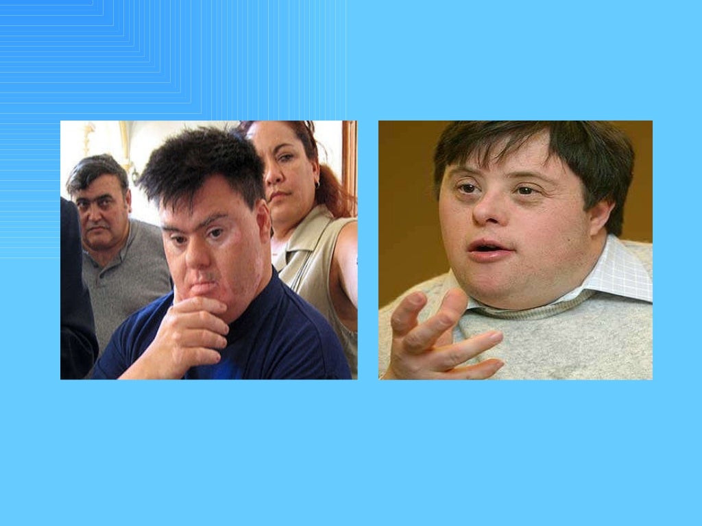 Sindrome de klinefelter Sindrome de klinefelter