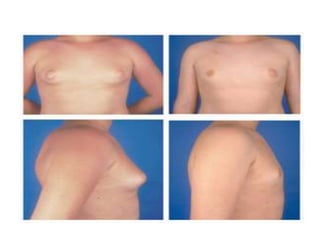 Sindrome de klinefelter