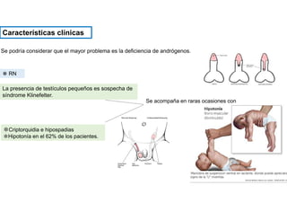 Se podría considerar que el mayor problema es la deficiencia de andrógenos.
Características clínicas
❋ RN
✽Criptorquidia e hipospadias
✽Hipotonía en el 62% de los pacientes.
Se acompaña en raras ocasiones con
La presencia de testículos pequeños es sospecha de
síndrome Klinefelter.
 