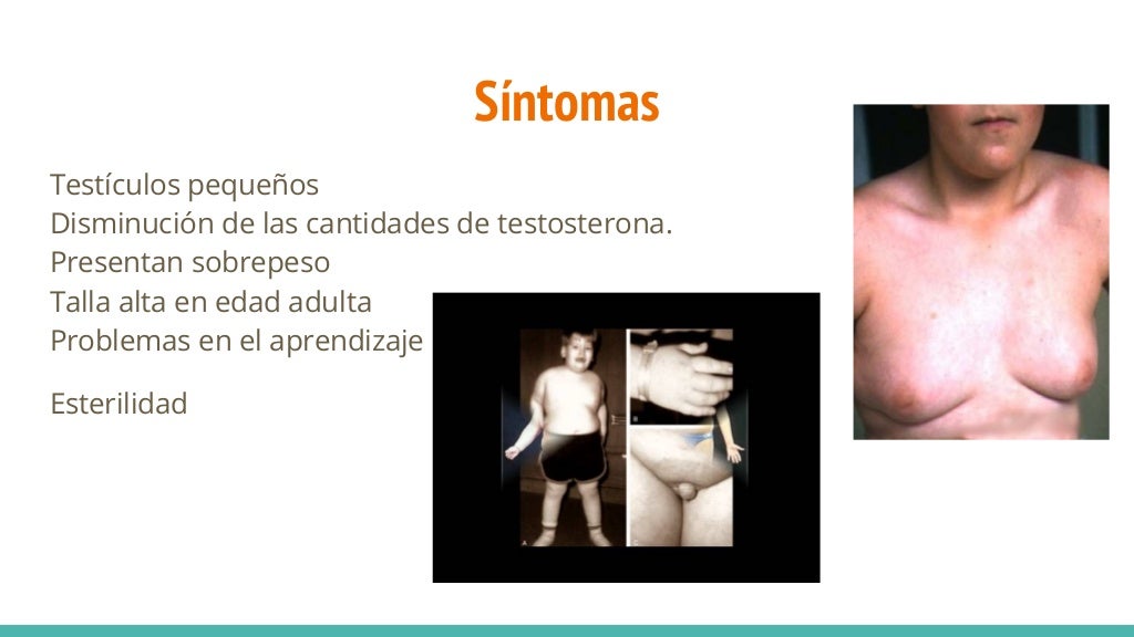Sindrome de klinefelter Sindrome de klinefelter