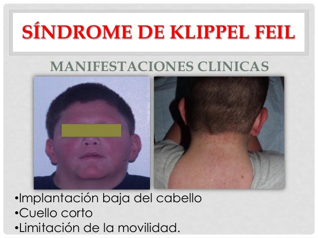 Resultado de imagen para SÃ­ndrome de Klippel Feil