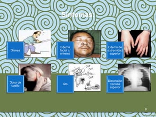 Síntomas:



           Edema        Edema de
Disnea     facial c/    extremidad
           eritema       superior




                        Distensión
Dolor de
             Tos         venosa
 cuello
                         superior




                                     9
 