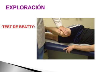 EXPLORACIÓN TEST DE BEATTY: Cadera flexionada y se realiza una abducción del muslo afectado, manteniendo esa posición unos segundos.  