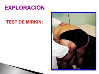 EXPLORACIÓN TEST DE MIRKIN: En bipedestación, manteniendo las rodillas rectas e inclinándose lentamente hacia el suelo y presionar sobre la nalga en el lugar donde el nervio ciático cruza al músculo piriforme, produciendo dolor que se extiende por cara dorsal del muslo. 