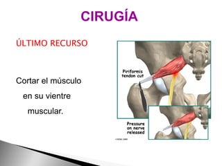 ÚLTIMO RECURSO Cortar el músculo  en su vientre  muscular. CIRUGÍA 