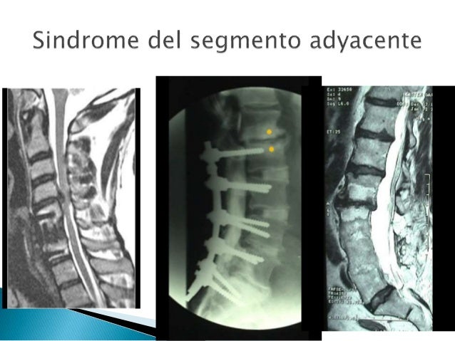 Resultado de imagen de patología segmento adyacente