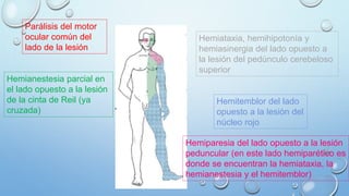 Parálisis del motor 
ocular común del 
lado de la lesión 
Hemiataxia, hemihipotonía y 
hemiasinergia del lado opuesto a 
la lesión del pedúnculo cerebeloso 
superior 
Hemianestesia parcial en 
el lado opuesto a la lesión 
de la cinta de Reil (ya 
cruzada) 
Hemitemblor del lado 
opuesto a la lesión del 
núcleo rojo 
Hemiparesia del lado opuesto a la lesión 
peduncular (en este lado hemiparético es 
donde se encuentran la hemiataxia, la 
hemianestesia y el hemitemblor) 
 