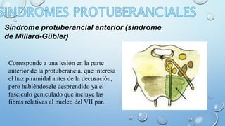 Síndrome protuberancial anterior (síndrome 
de Millard-Gübler) 
Corresponde a una lesión en la parte 
anterior de la protuberancia, que interesa 
el haz piramidal antes de la decusación, 
pero habiéndosele desprendido ya el 
fascículo geniculado que incluye las 
fibras relativas al núcleo del VII par. 
 