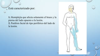 Está caracterizado por: 
1. Hemiplejía que afecta solamente el brazo y la 
pierna del lado opuesto a la lesión. 
2. Parálisis facial de tipo periférico del lado de 
la lesión. 
 