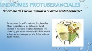 Síndrome de Foville inferior o “Foville protuberancial” 
En este caso, la lesión, además de afectar las 
fibras piramidales y las del nervio facial, 
interesa el fascículo longitudinal medio (ya 
cruzado), por lo que la desviación de la mirada 
se hace en sentido opuesto a la de las lesiones 
pedunculares. 
 