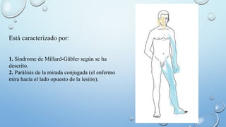Está caracterizado por: 
1. Síndrome de Millard-Gübler según se ha 
descrito. 
2. Parálisis de la mirada conjugada (el enfermo 
mira hacia el lado opuesto de la lesión). 
 
