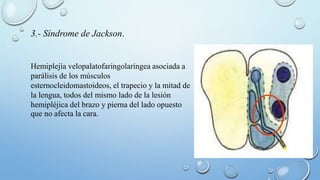 3.- Síndrome de Jackson. 
Hemiplejía velopalatofaringolaríngea asociada a 
parálisis de los músculos 
esternocleidomastoideos, el trapecio y la mitad de 
la lengua, todos del mismo lado de la lesión 
hemipléjica del brazo y pierna del lado opuesto 
que no afecta la cara. 
 