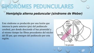 Hemiplejía alterna peduncular (síndrome de Weber) 
Este síndrome es producido por una lesión que 
interesa la parte anterior (pie) del pedúnculo 
cerebral, por donde desciende el haz piramidal y 
al mismo tiempo las fibras procedentes del núcleo 
del III par, que emergen del pedúnculo por esta 
región. 
 