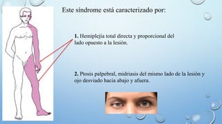 Este síndrome está caracterizado por: 
1. Hemiplejía total directa y proporcional del 
lado opuesto a la lesión. 
2. Ptosis palpebral, midriasis del mismo lado de la lesión y 
ojo desviado hacia abajo y afuera. 
 