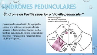 Síndrome de Foville superior o “Foville peduncular” 
Corresponde a una lesión de topografía 
similar a la anterior, pero que además 
interesa el fascículo longitudinal medio 
también denominado cintilla longitudinal 
posterior (ver anatomía funcional de los 
III, IV y VI pares). 
 