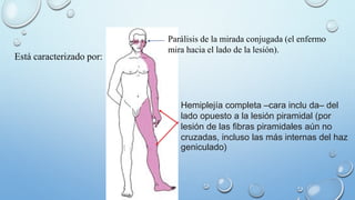 Está caracterizado por: 
Parálisis de la mirada conjugada (el enfermo 
mira hacia el lado de la lesión). 
Hemiplejía completa –cara inclu da– del 
lado opuesto a la lesión piramidal (por 
lesión de las fibras piramidales aún no 
cruzadas, incluso las más internas del haz 
geniculado) 
 