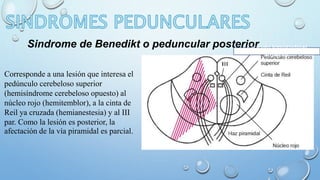 Sindrome de Benedikt o peduncular posteriFoacriculo longitudinal 
Corresponde a una lesión que interesa el 
pedúnculo cerebeloso superior 
(hemisíndrome cerebeloso opuesto) al 
núcleo rojo (hemitemblor), a la cinta de 
Reil ya cruzada (hemianestesia) y al III 
par. Como la lesión es posterior, la 
afectación de la vía piramidal es parcial. 
superior 
 